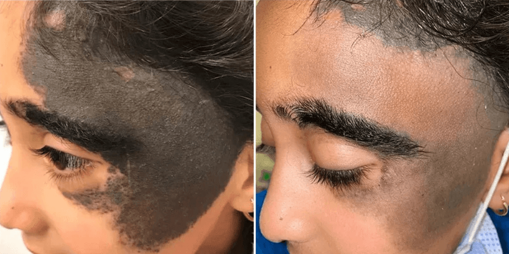 Birthmark Removal Treatment