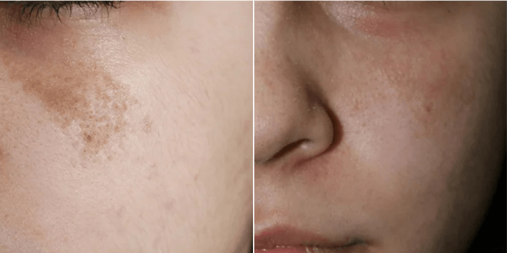 Birthmark Removal Treatment