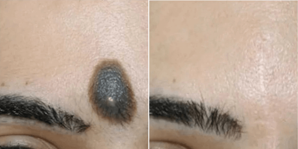 Birthmark Removal Treatment