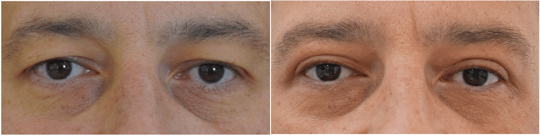 Blepharoplasty Treatment