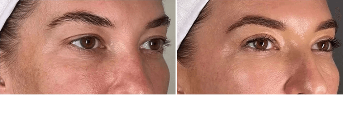 Blepharoplasty Treatment