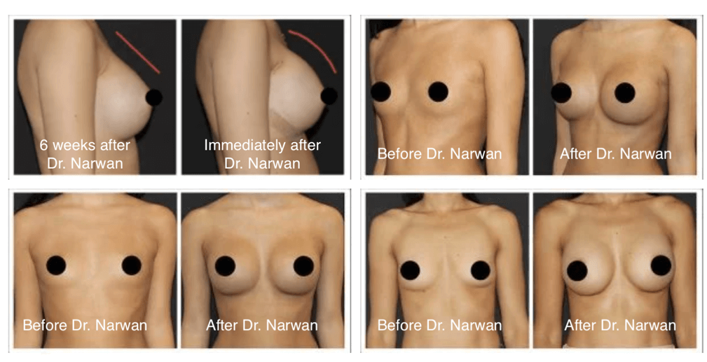 Breast Augmentation