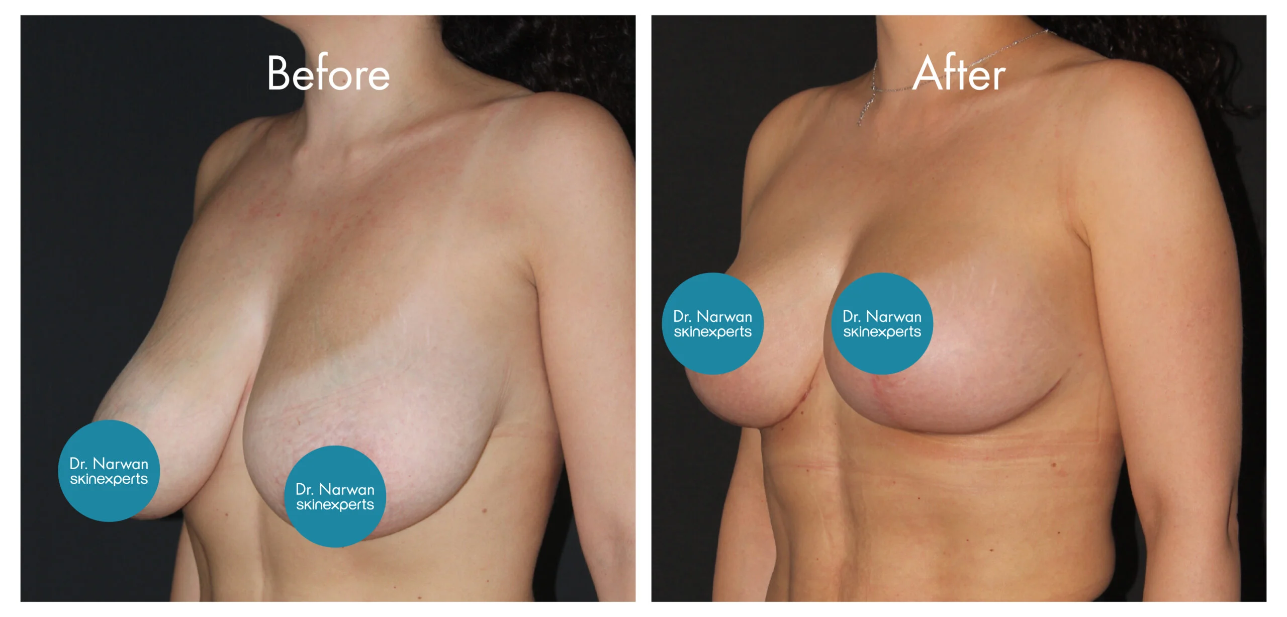 Breast Lift & Reduction