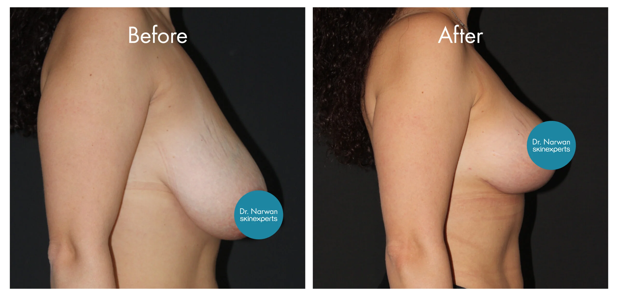 Breast Lift & Reduction