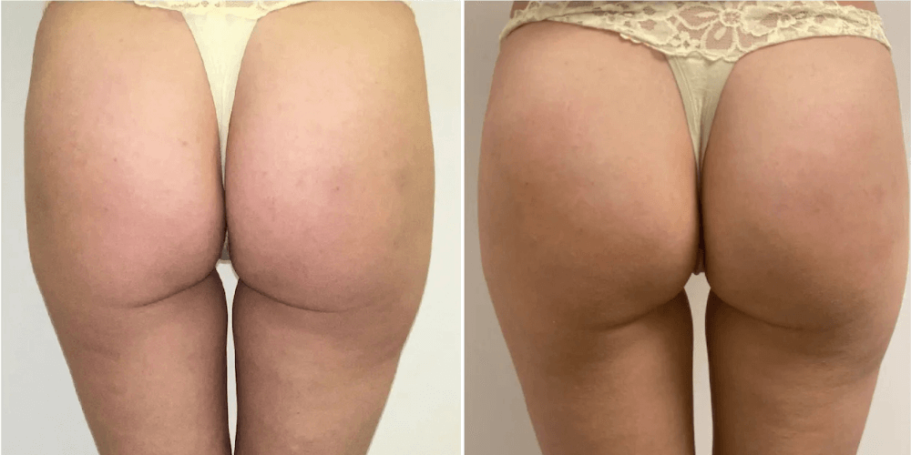 Buttock Filler Treatment