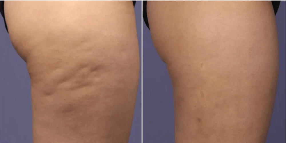 Cellulite Treatment