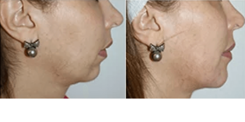 Chin Augmentation