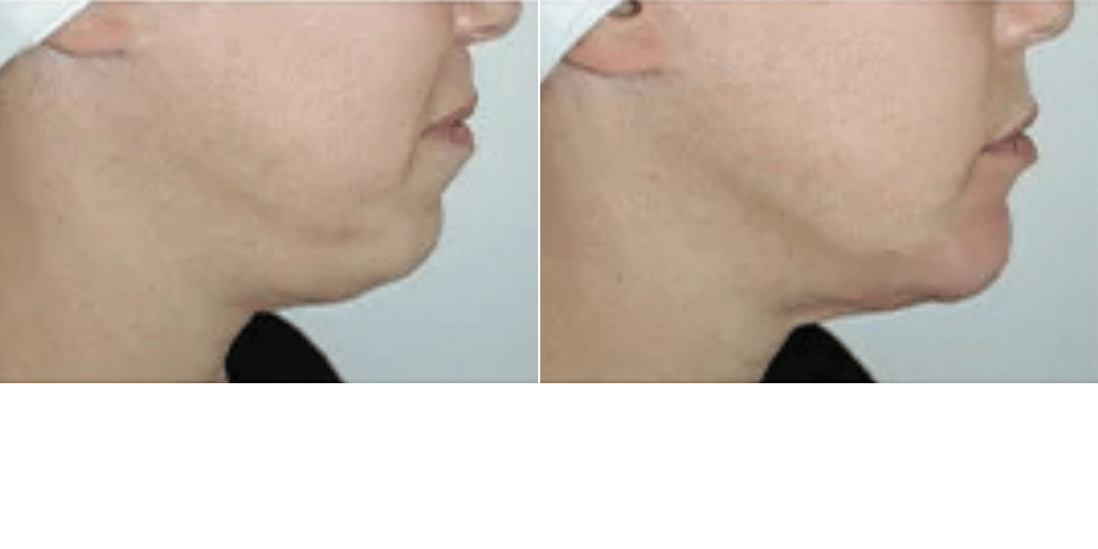 Chin Augmentation