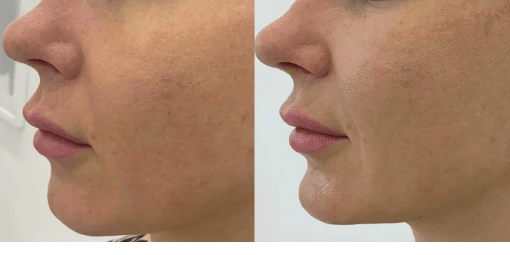 Chin Augmentation