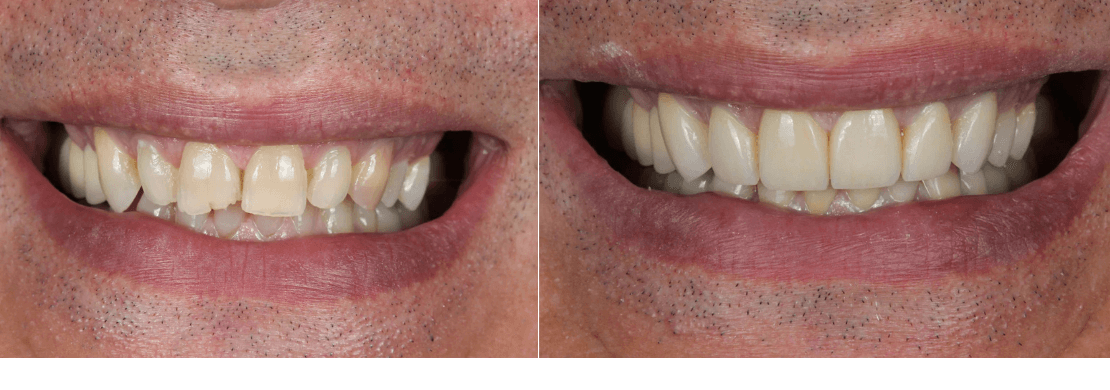 Crown and Dental Bridge