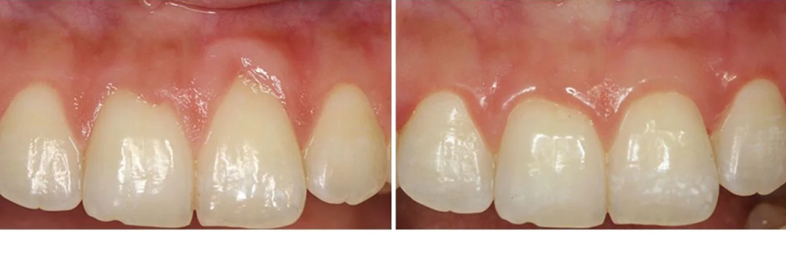 Crown and Dental Bridge