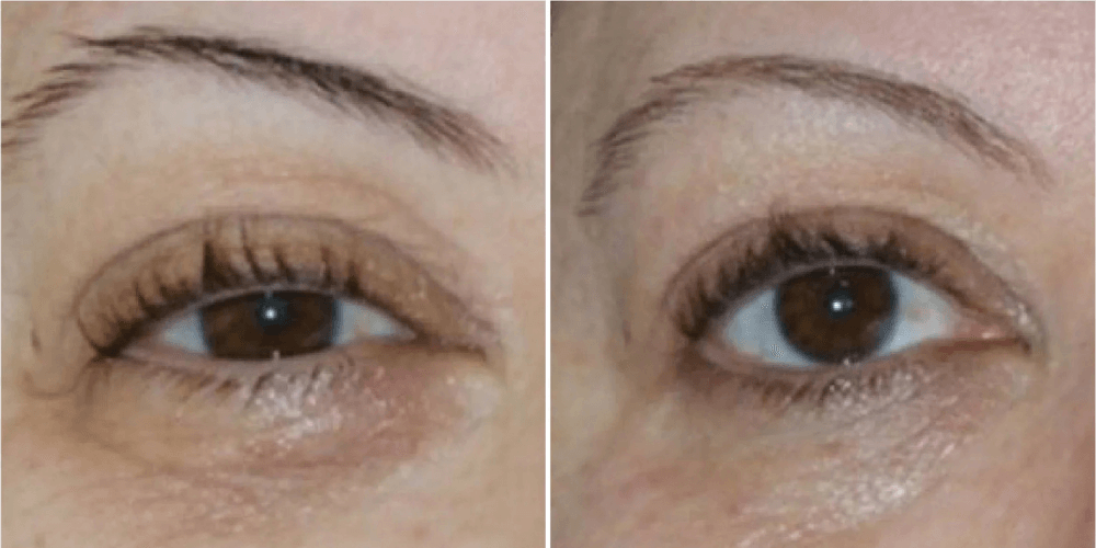 Eyelid Rejuvenation & Dark Circle Treatment