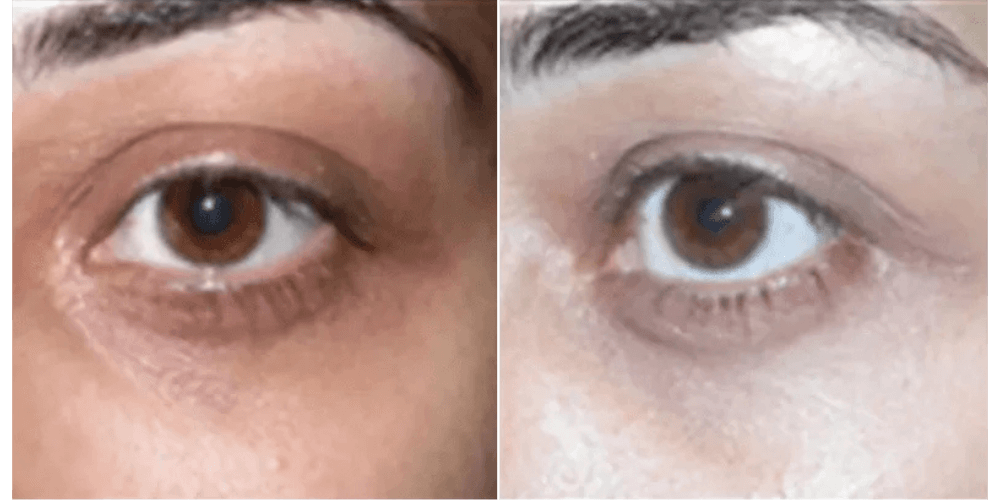 Eyelid Rejuvenation & Dark Circle Treatment