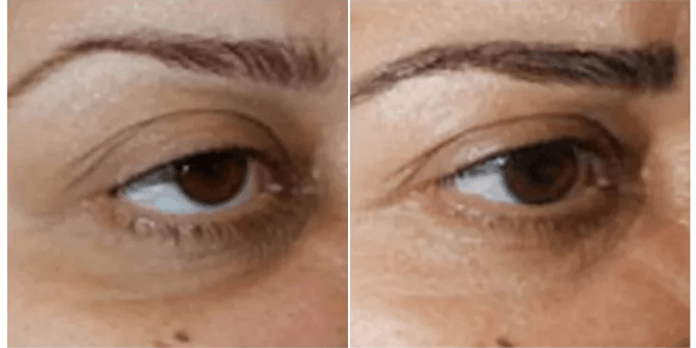 Eyelid Rejuvenation & Dark Circle Treatment