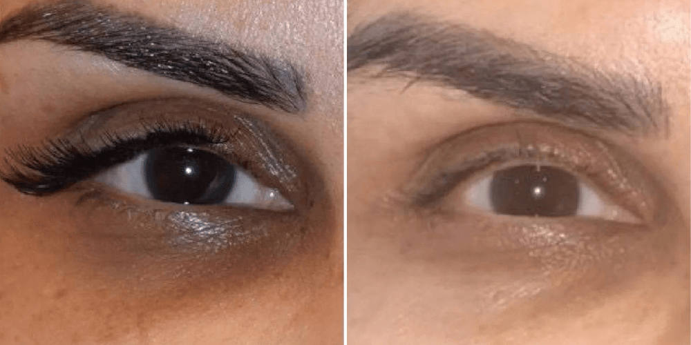 Eyelid Rejuvenation & Dark Circle Treatment