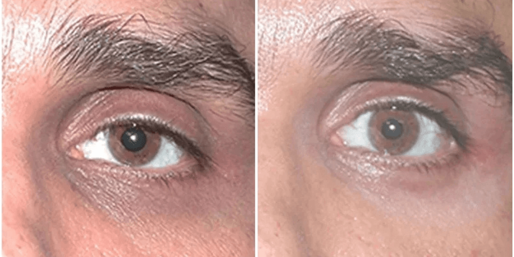 Eyelid Rejuvenation & Dark Circle Treatment