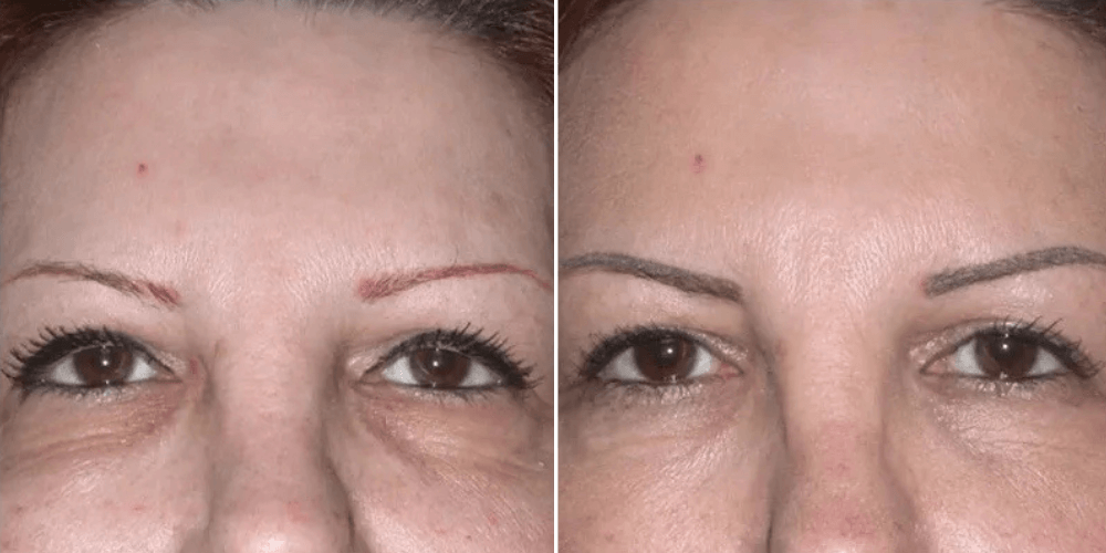 Eyelid Rejuvenation & Dark Circle Treatment