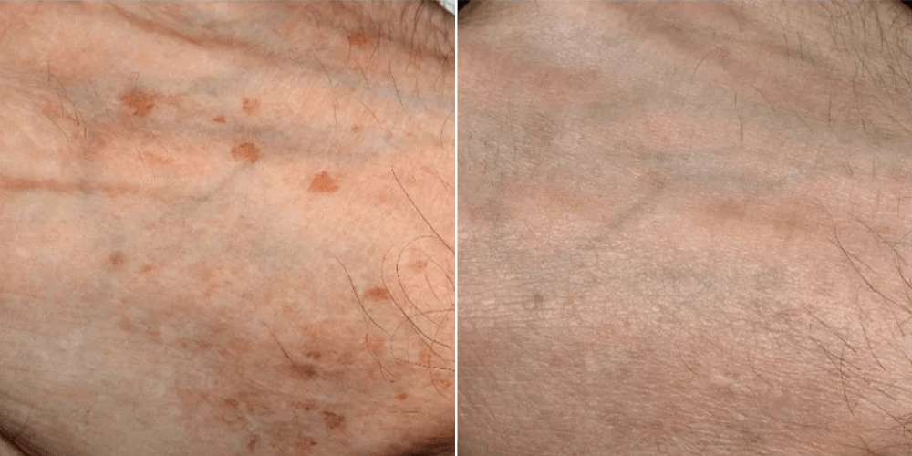 Scar, Dark Spot & Melasma Treatment