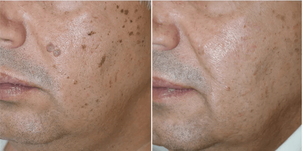 Scar, Dark Spot & Melasma Treatment