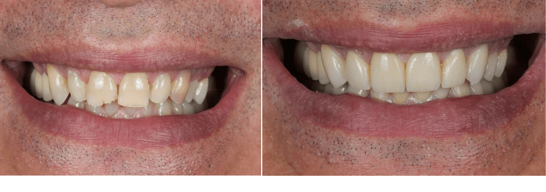 Dental Restoration
