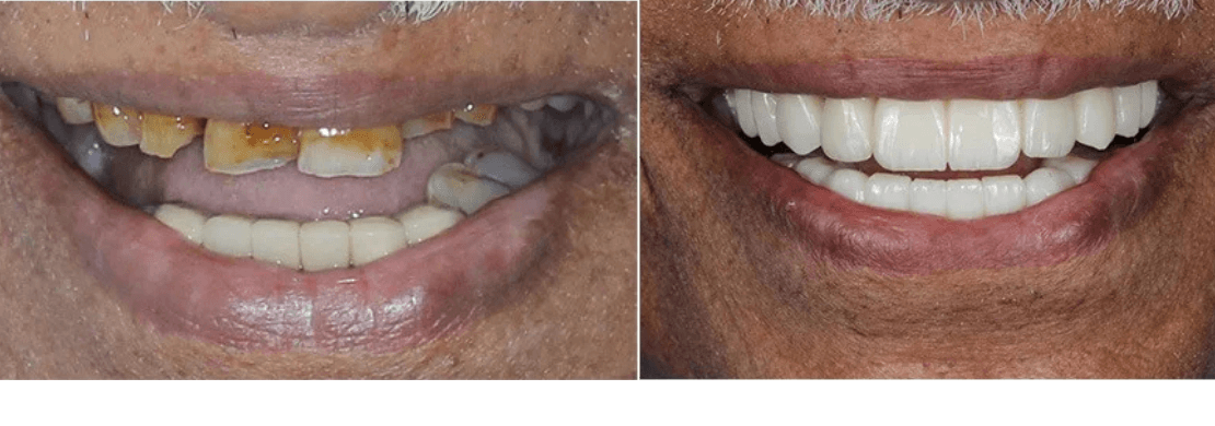 Dental Restoration