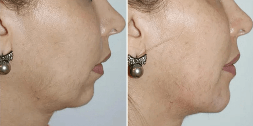 Dermal Filler Treatment