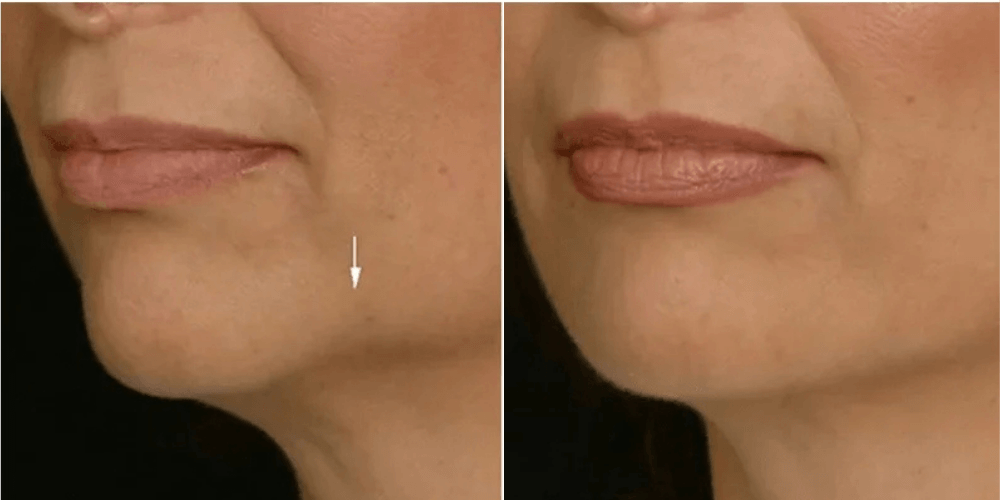 Dermal Filler Treatment