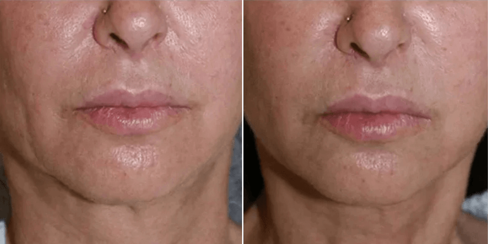 Dermal Filler Treatment