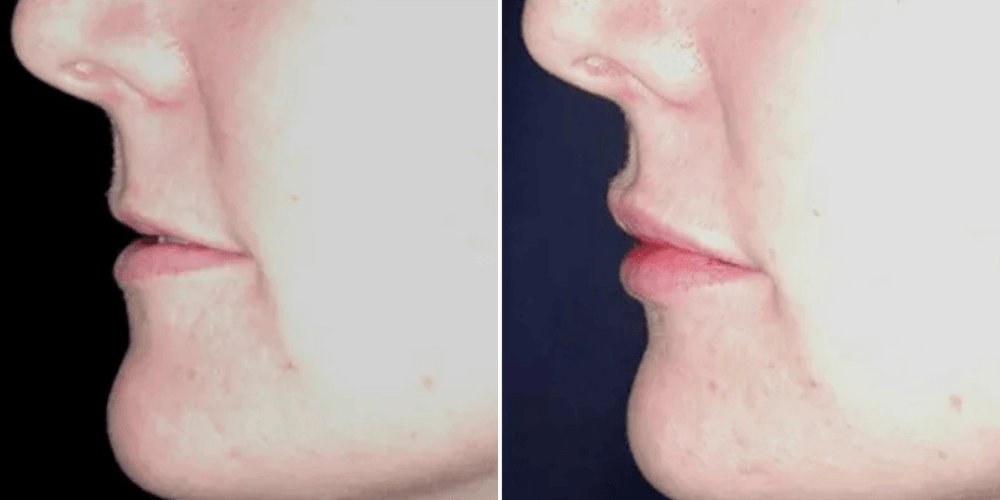 Dermal Filler Treatment