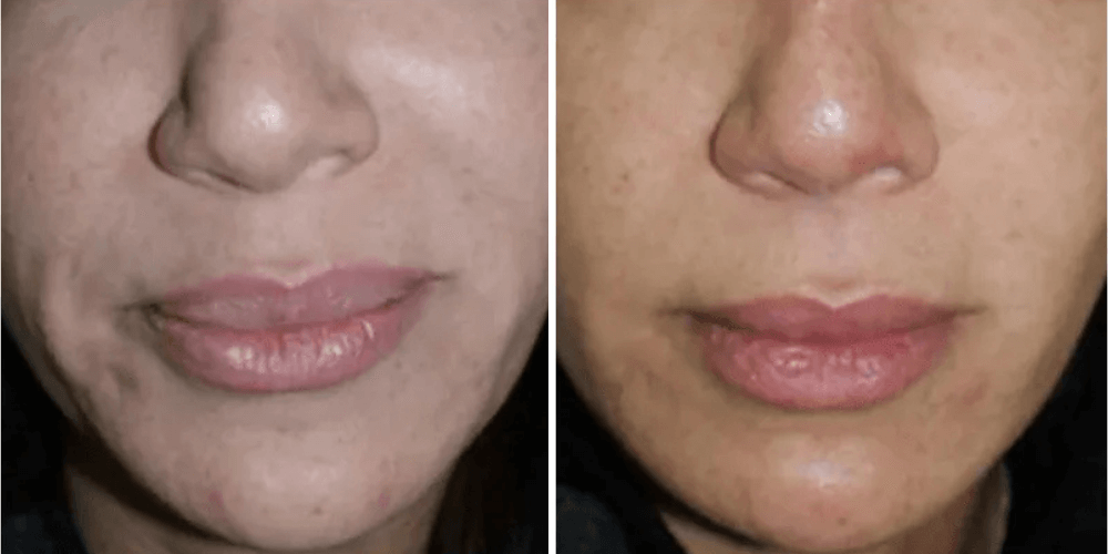 Dermal Filler Treatment
