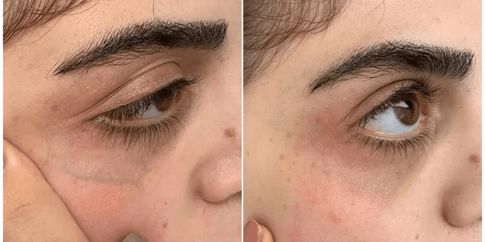 Eyelid Rejuvenation & Dark Circle Treatment