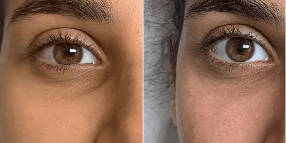 Eyelid Rejuvenation & Dark Circle Treatment