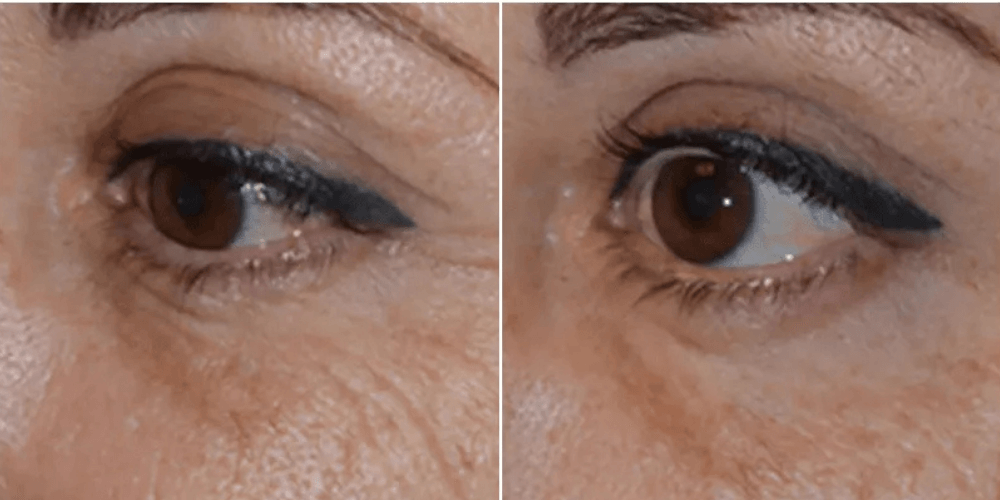 Eyelid Rejuvenation & Dark Circle Treatment