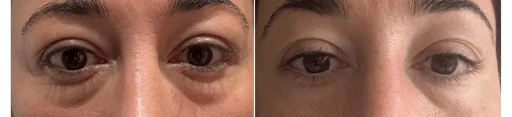 FEyelid Rejuvenation & Dark Circle Treatment