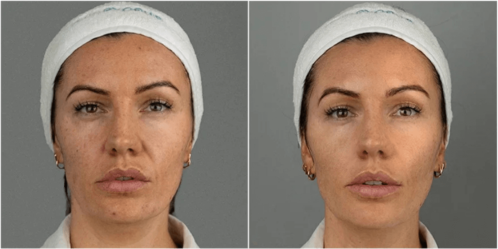Facial Rejuvination