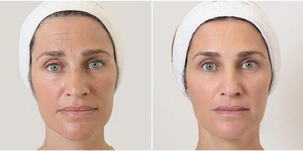 Facial Rejuvination
