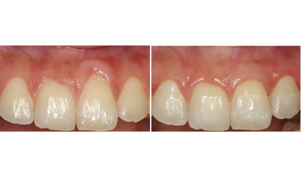 Gum and Periodontal Disease