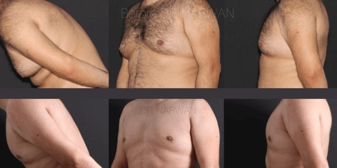 Gynecomastia