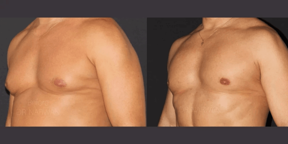 Gynecomastia