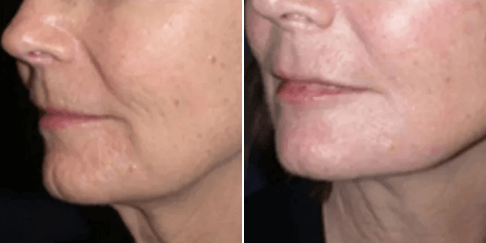 HIFU (High-Intensity Focused Ultrasound)