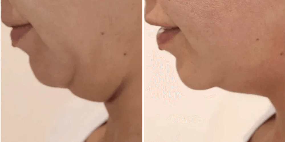 HIFU (High-Intensity Focused Ultrasound)