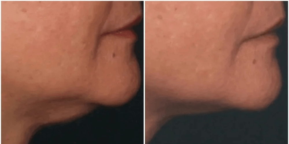 HIFU (High-Intensity Focused Ultrasound)