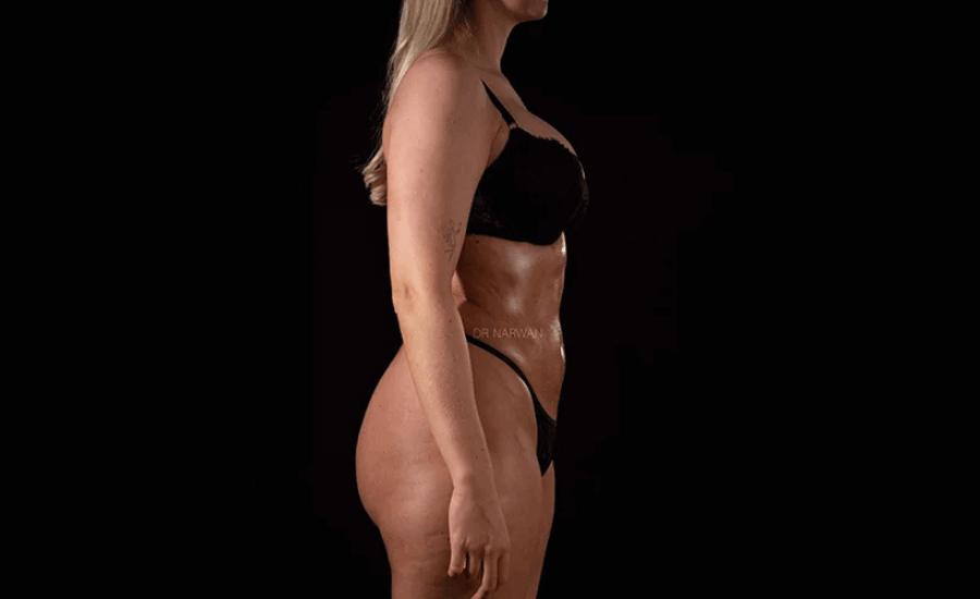 High Defination Body Contouring for Women