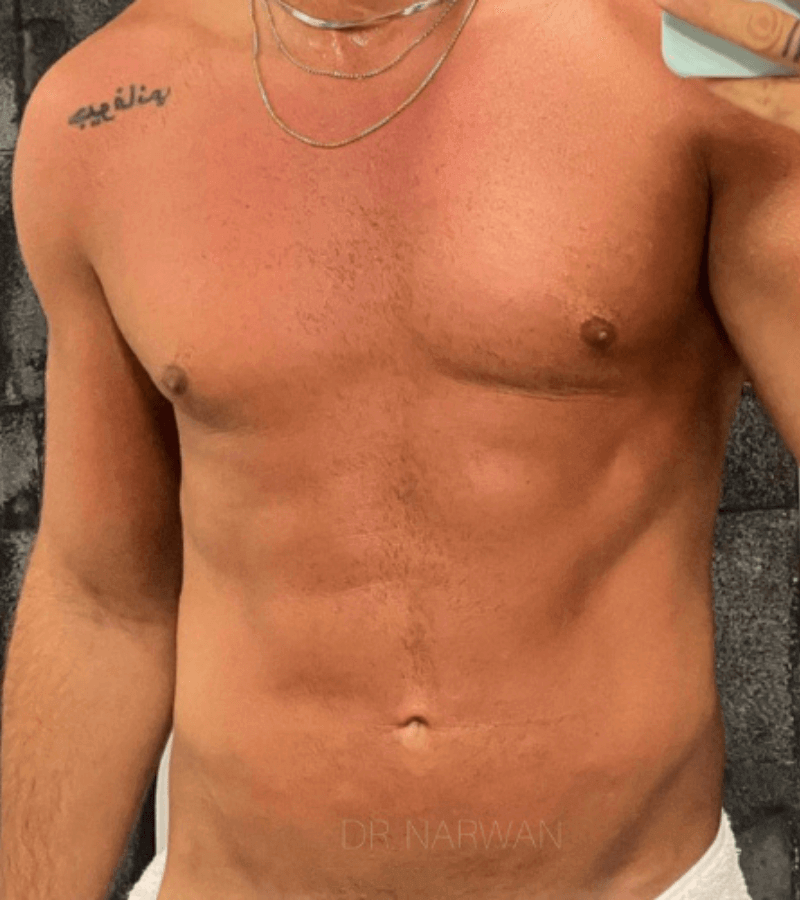 High Defination Body Contouring for Men