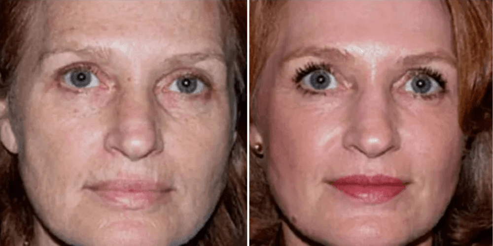 Laser Resurfacing Treatment