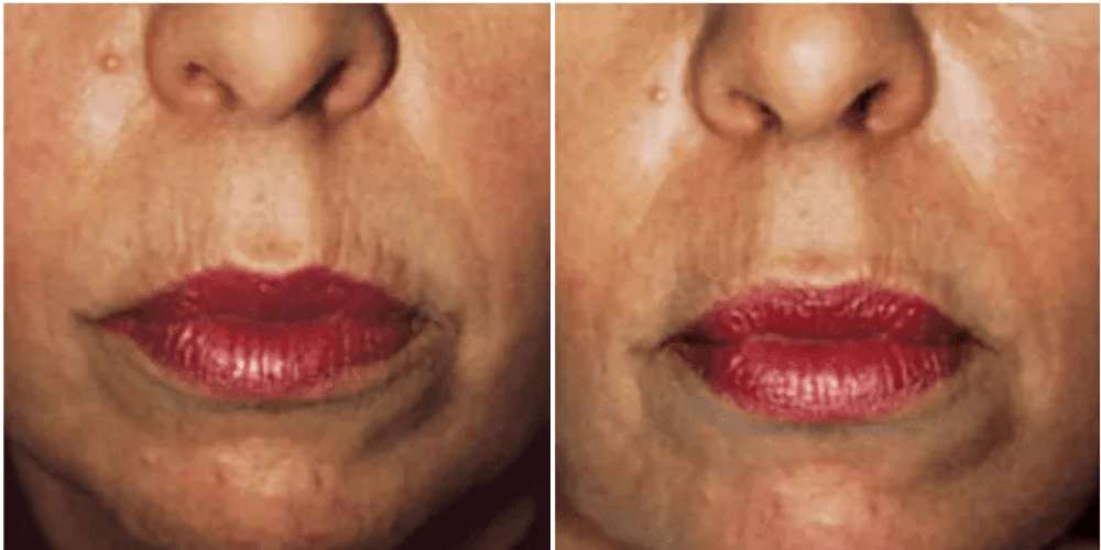 Laser Resurfacing Treatment