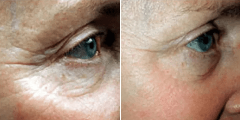 Laser Resurfacing Treatment