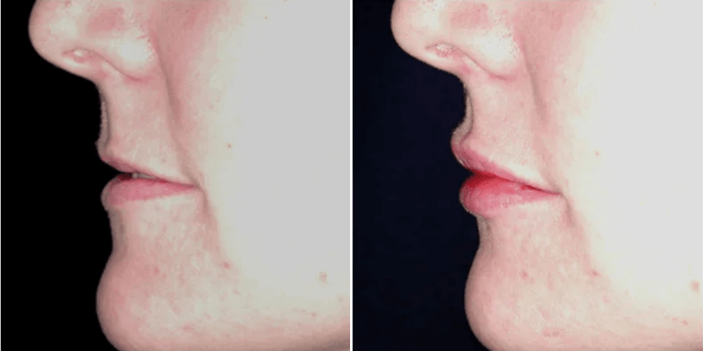 Lip Rejuvenation Augmentation