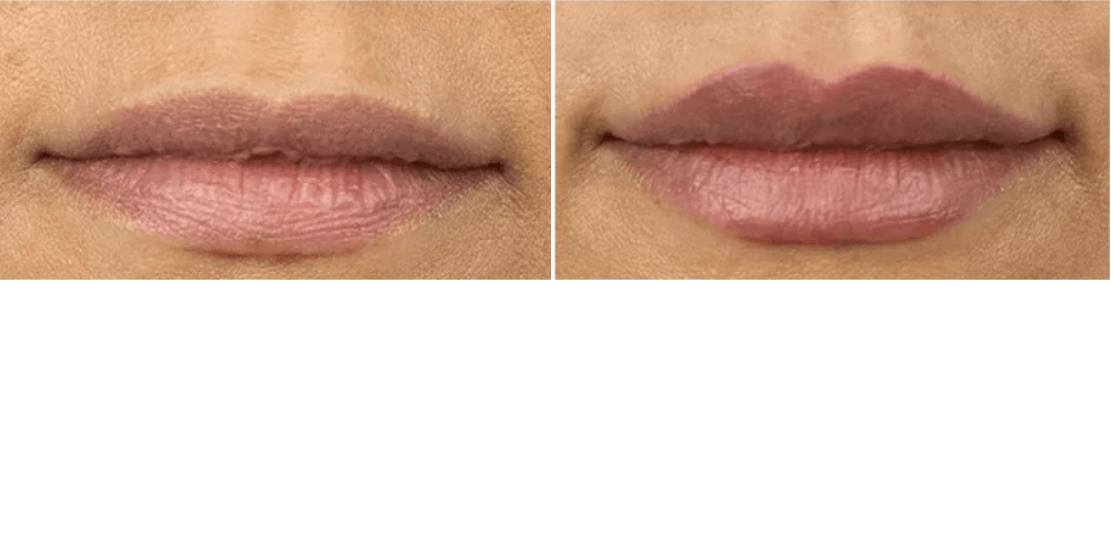 Lip Rejuvenation Augmentation