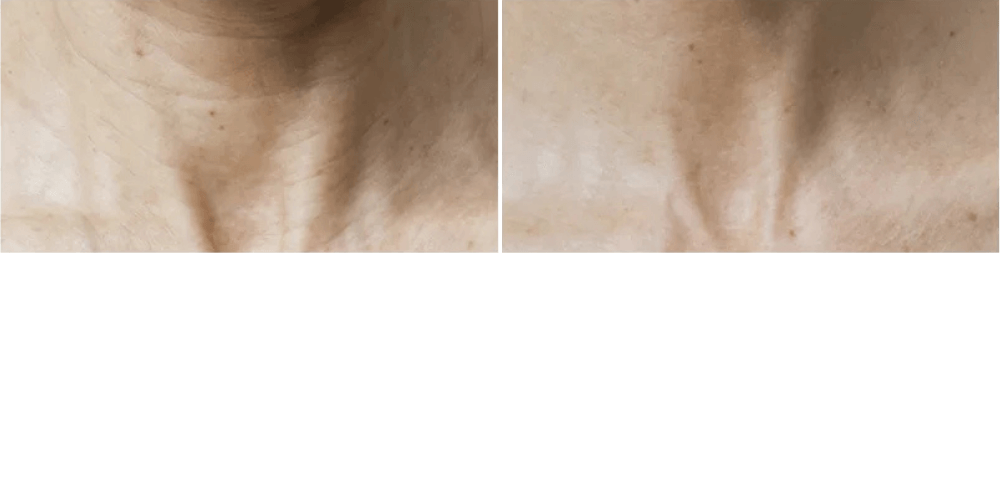 Mesotherapy Treatment